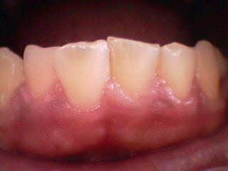 歯肉メラニン色素沈着除去・レーザー照射後　痛そうに見えますが全然いたくありません。