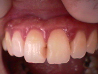 妊娠性歯肉炎；歯石除去前